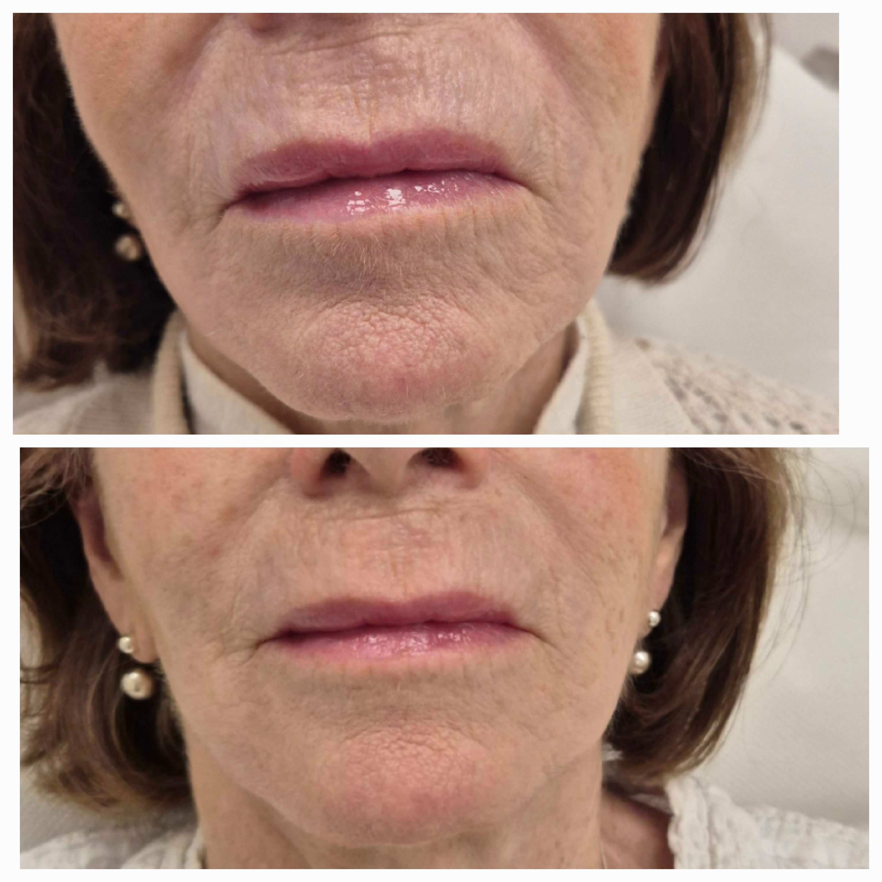 Sunekos Skin Booster Clinical Treatment