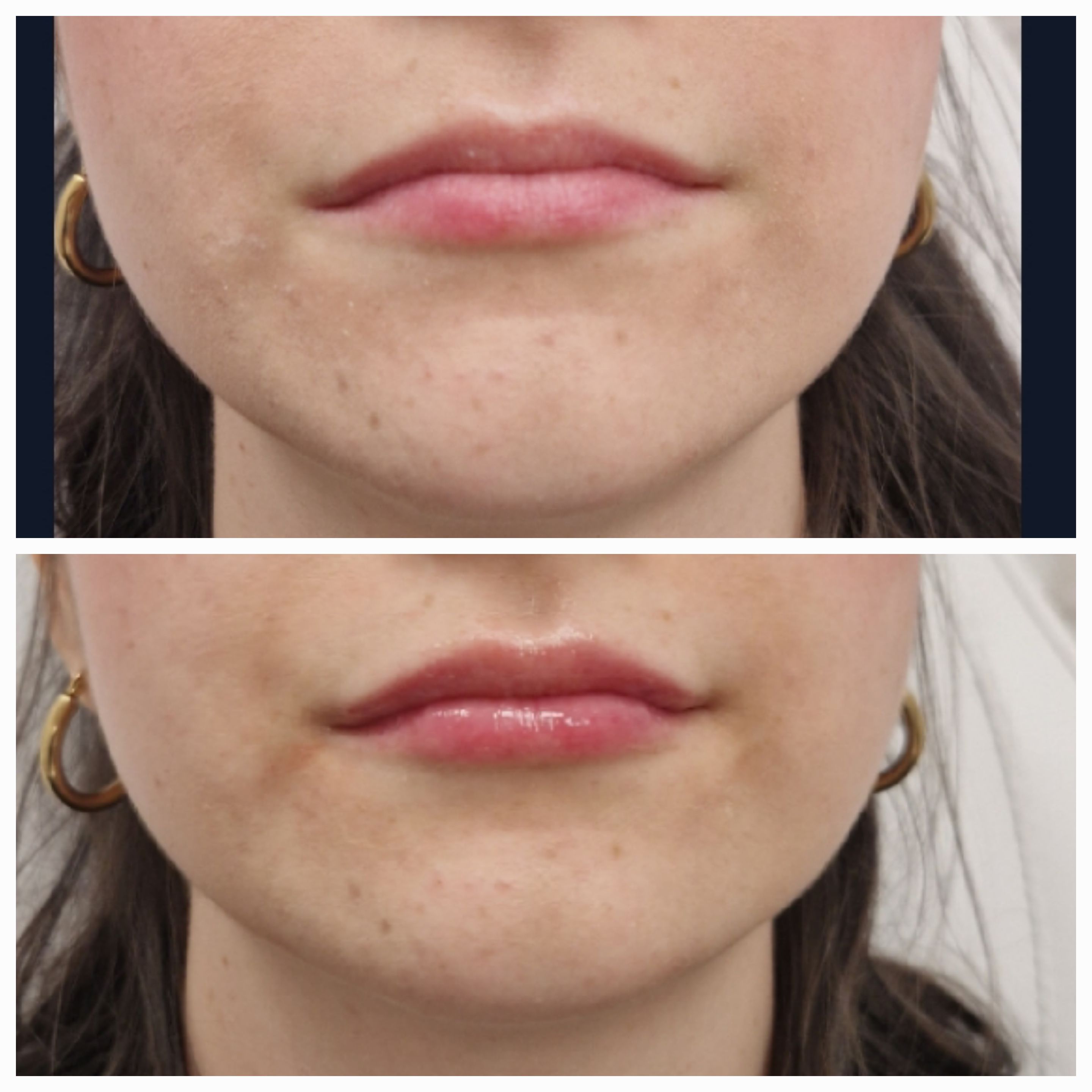 Natural Dermal Lip Filler Result - Volume and Definition