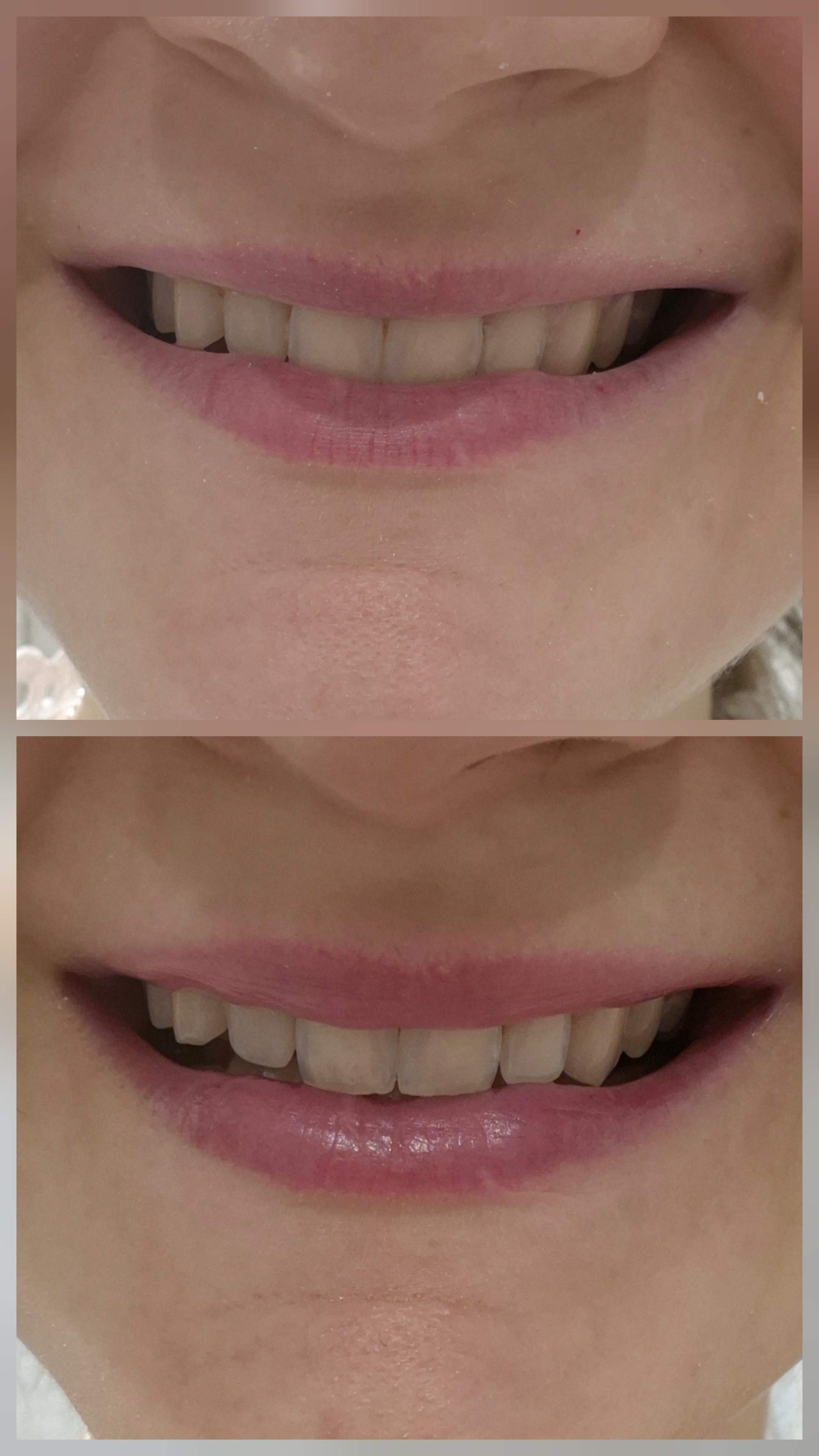 Advanced Lip Flip Combination Result